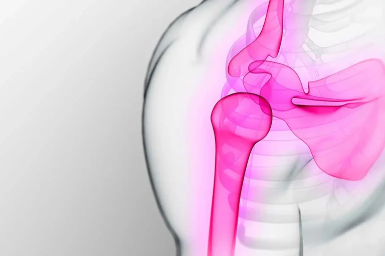 Cas client Polynomik : Epaule au TOP